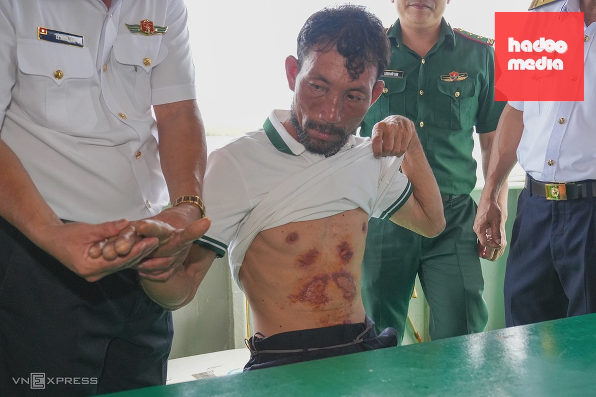 Ông Trung với nhiều vết xước ở bụng do ma sát với bề mặt tấm xốp. Ảnh: Trường Hà