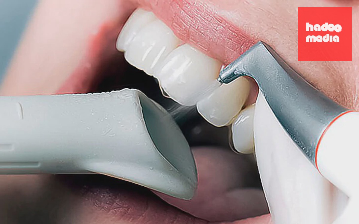 Bọc răng sứ tràn lan, coi chừng vừa mất tiền, mất răng vì điều trị quá mức - Ảnh 1.